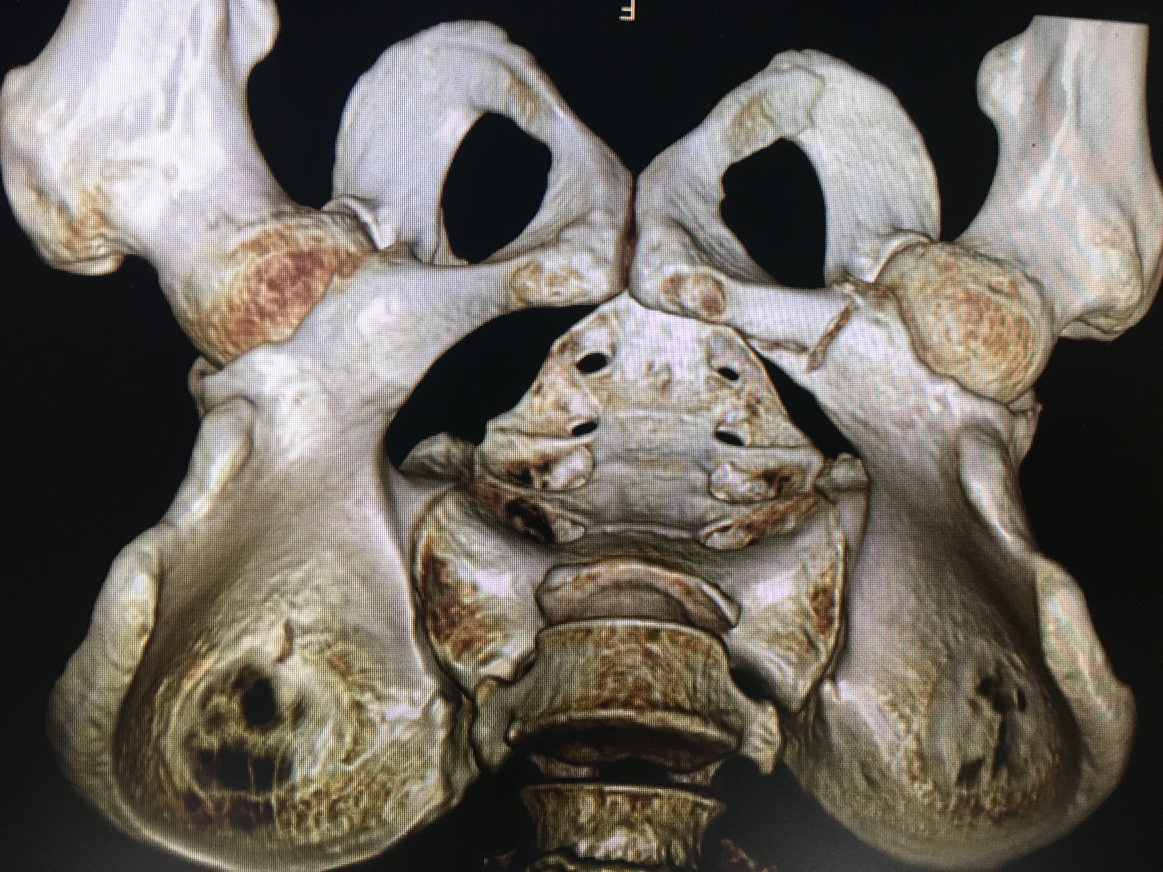 一名骨科医生股骨骨折经历,骨科朱医生