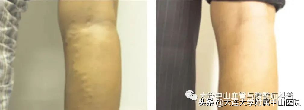 科普知识日间手术轻松搞定蚯蚓腿,日间手术知识科普