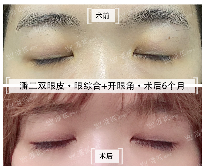 双眼皮眼尾割长了而且上扬怎么办,眼睛眼尾下垂做什么样双眼皮