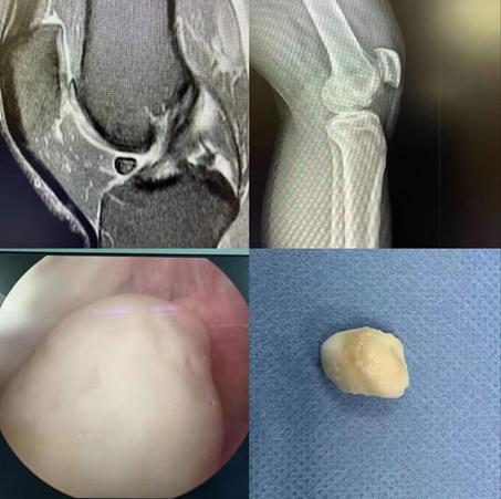 膝关节不适对应的病症,膝关节痛是股骨头坏死引起的吗