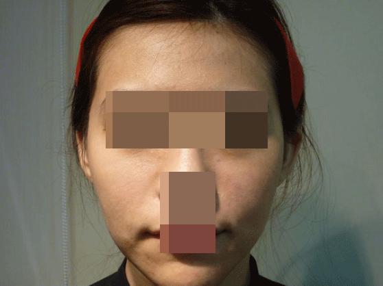 30岁皮肤松弛法令纹重怎么办,30多岁长了法令纹怎么办