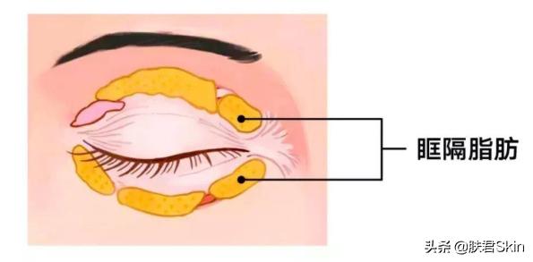 有什么沟必须火的,泪沟后面有一条很深的沟叫什么