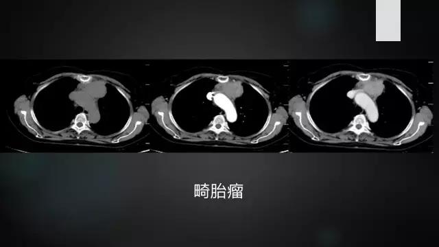 前上纵隔高密度影考虑胸腺未退化,肺纵隔胸腺结节12mm看什么科