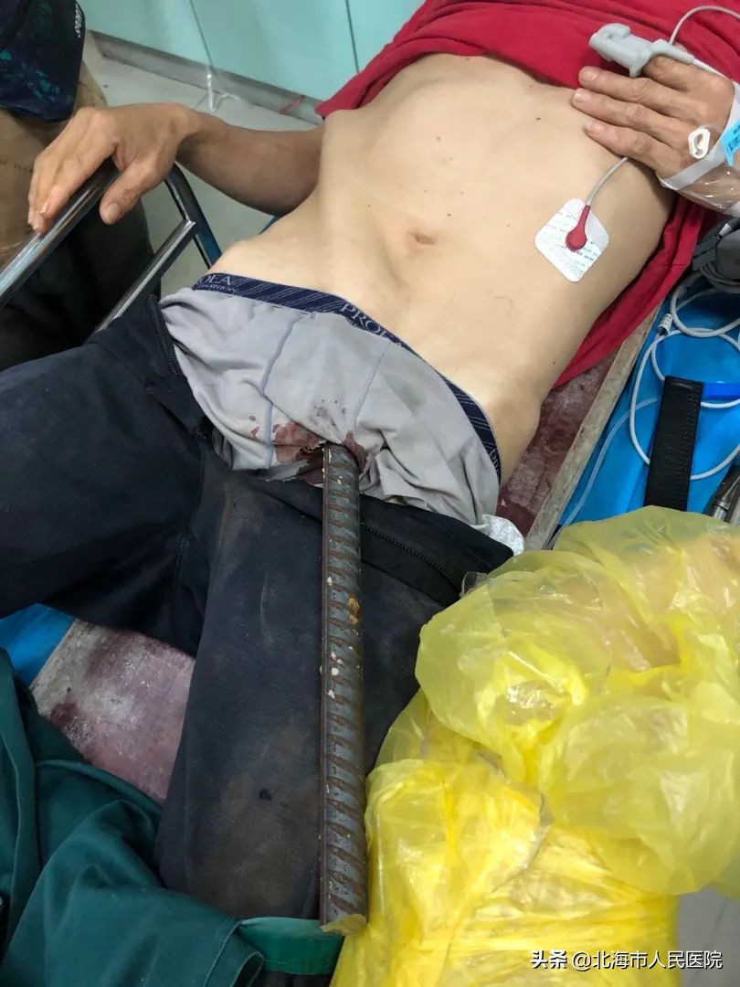 可怕!北海48岁工人被钢筋从*体下**穿入,所幸受伤较轻内脏无损伤
