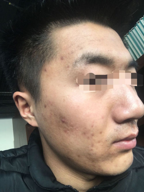 痘坑痘印|战“痘”达人的护理经验分享，内附修复攻略