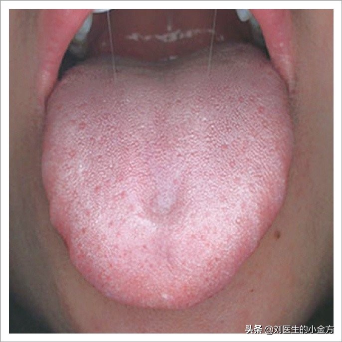 中医舌诊对照表100例,舌诊辨九大体质