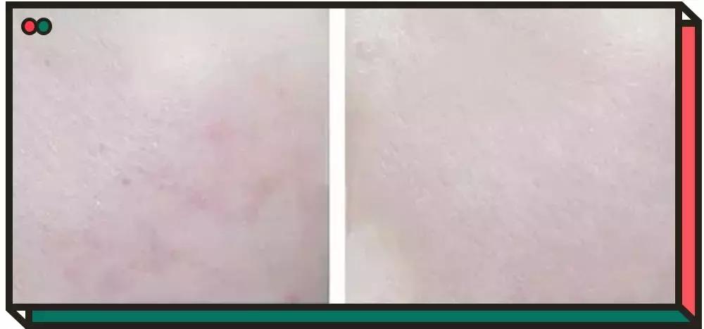 黛珂紫苏水祛痘,黛珂紫苏水祛痘吗