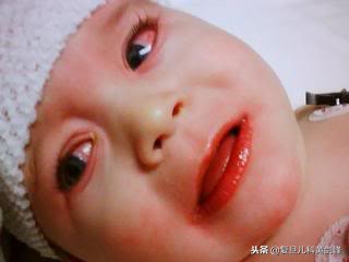 发热白细胞高达25什么原因,发热白细胞高c反应蛋白高