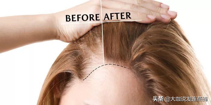 毛囊养护真的能长出新的头发吗,护发要注意什么