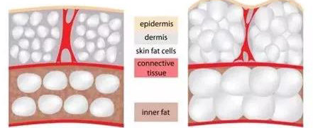 因肥胖撑出的纹怎么去除,因为肥胖导致的胖纹怎么消掉