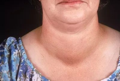 桥本氏甲状腺炎甲亢会自愈吗,桥本氏甲状腺炎自愈的方法