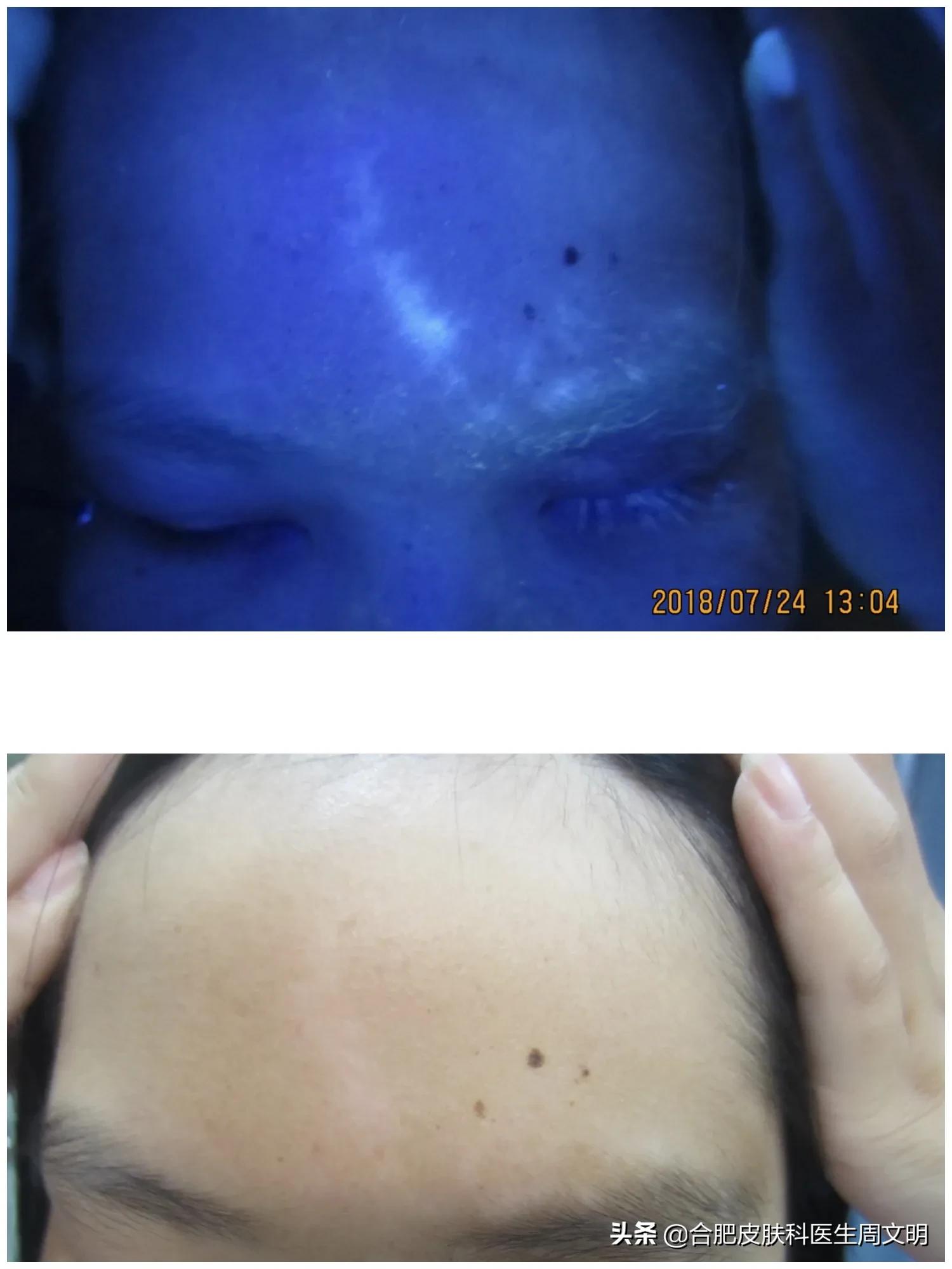 白斑复色案例,白斑快速复色