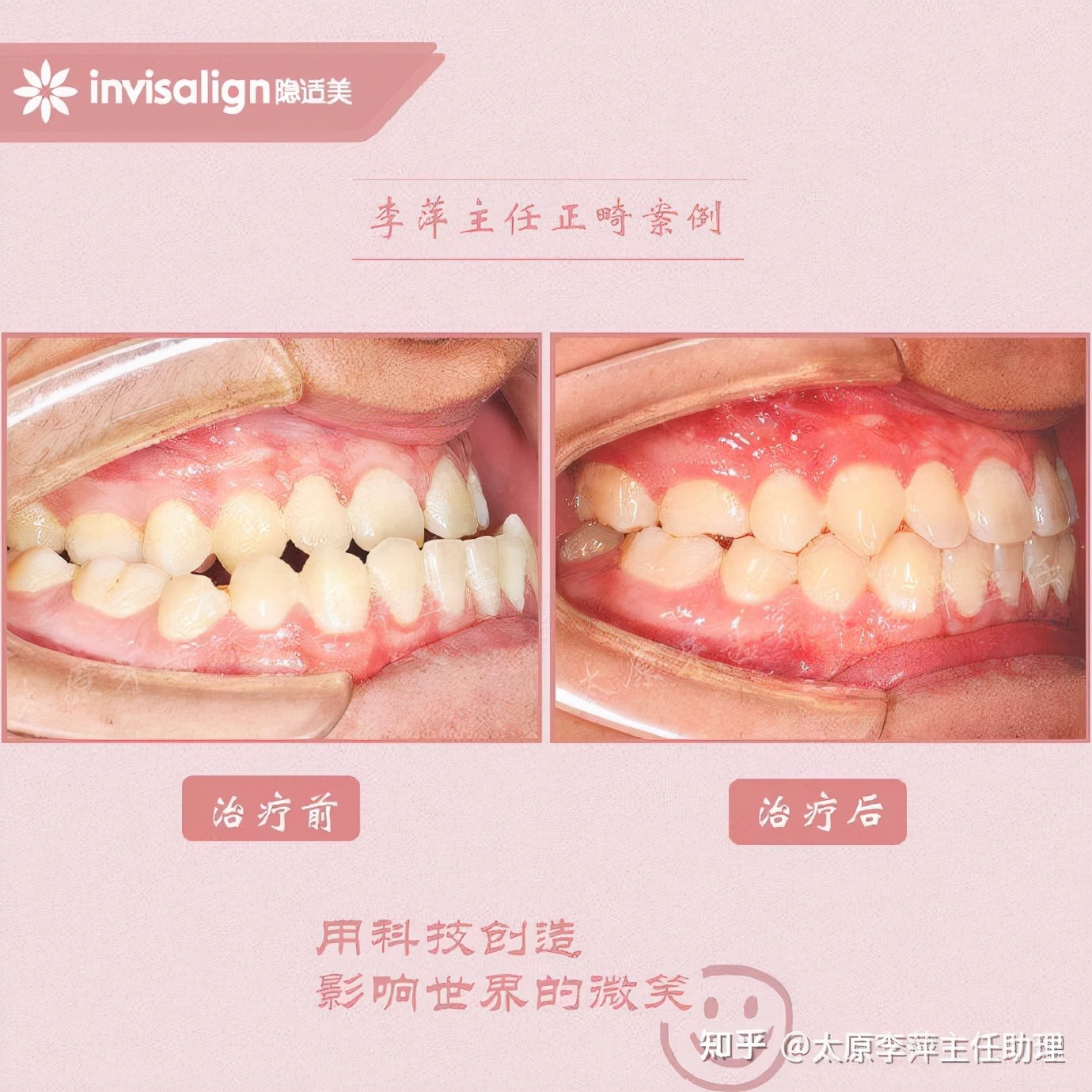 重度拥挤矫正牙齿适合隐形牙套吗,广州成人牙齿矫正推荐隐形牙套