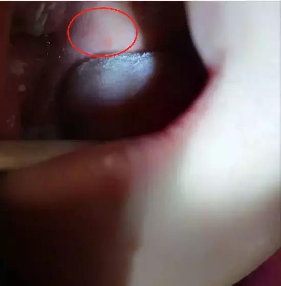 这一步才是治疗疱疹性咽峡炎的关键！做好预防和护理注意3件事