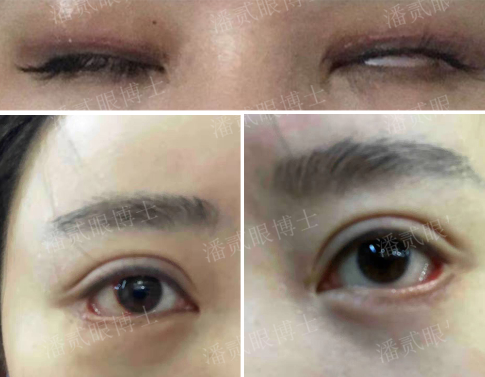 整形医院做双眼皮怎么不被坑,整形医院做双眼皮失败如何投诉