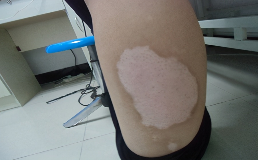 白癜风是否在康复？需要满足这5个条件