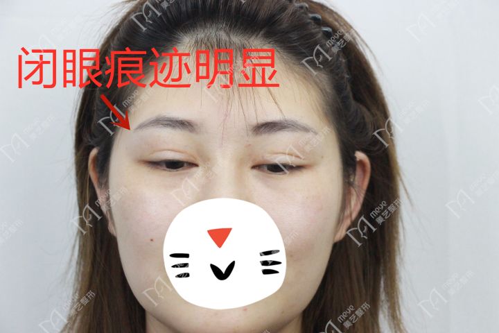 双眼皮线条凹陷疤痕怎么修复,双眼皮手术后如何避免疤痕和增生