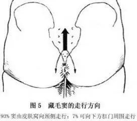 屁屁上有毛球怎么回事,臀部长毛的原因是激素分泌旺盛吗