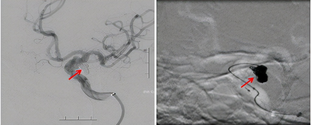 眼皮突然下垂看东西重影,突然大小眼右眼眼皮耷拉