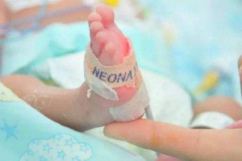 生了唐氏婴儿怎么处理,生个早产儿