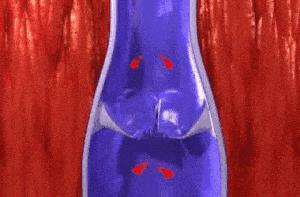 腿上有蚯蚓纹怎么回事,腿上出现蚯蚓似的纹路是怎么回事