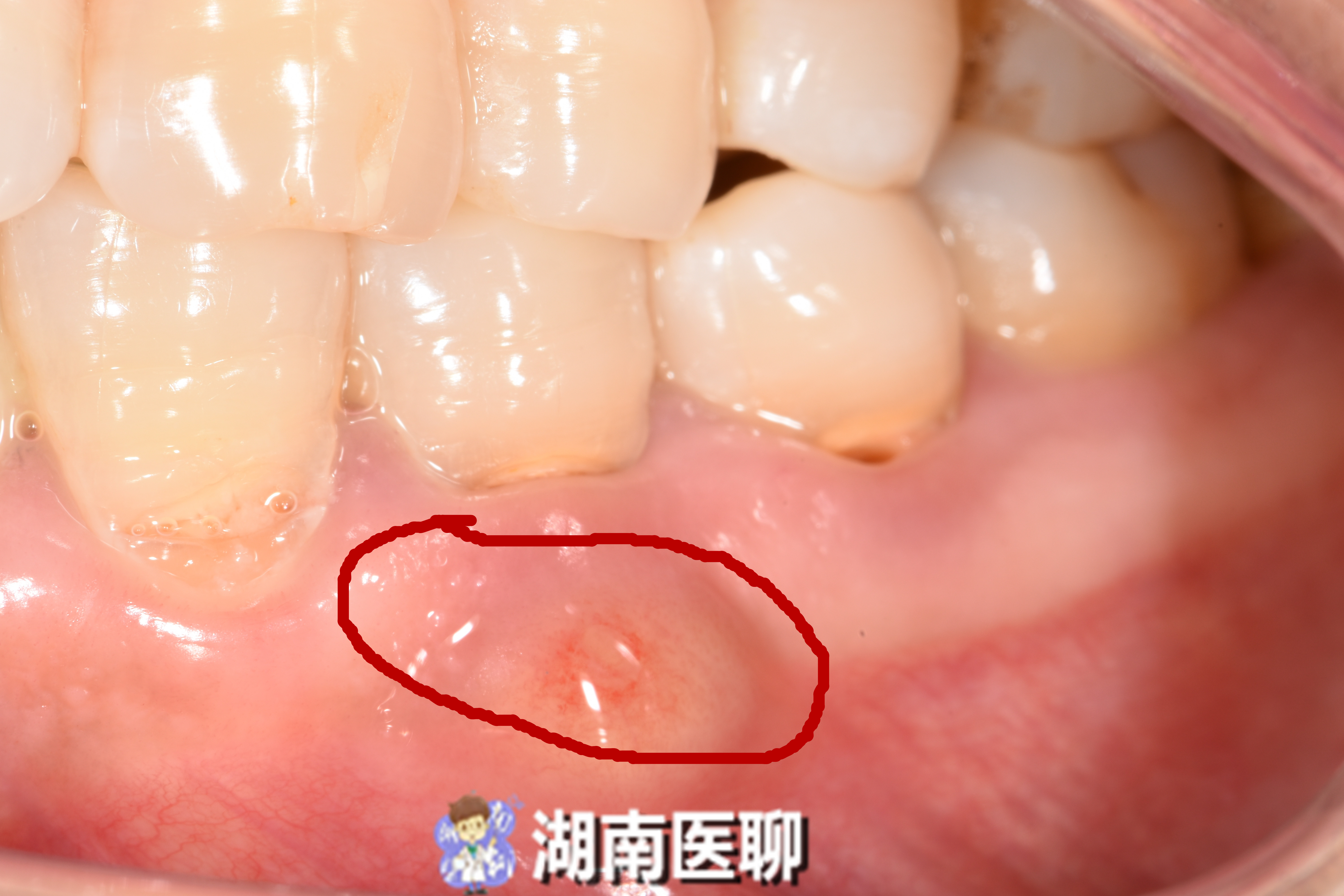 牙齿有洞很痛可以用牙痛药水吗,牙齿疼痛怎么办土方法治牙疼