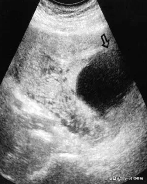 剖宫产疤痕妊娠动画,剖宫产疤痕妊娠的临床分型