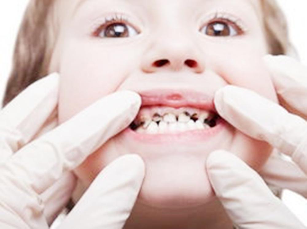 小孩满口牙蛀牙是怎么回事,孩子满嘴蛀牙严重能修复吗