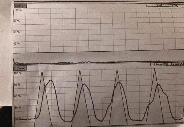 ella自曝产后后遗症,ella自曝产后尿失禁