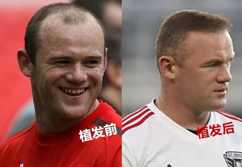 威廉王子秃顶了哈里为啥没秃顶,威廉王子为什么喜欢秃顶