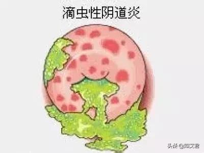 女生们都来了解滴虫性阴道炎，教你如何知道患上了滴虫性阴道炎