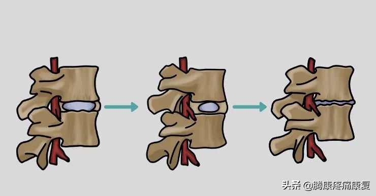 腰椎滑脱的治疗与锻炼图片,腰椎滑脱的治疗与锻炼