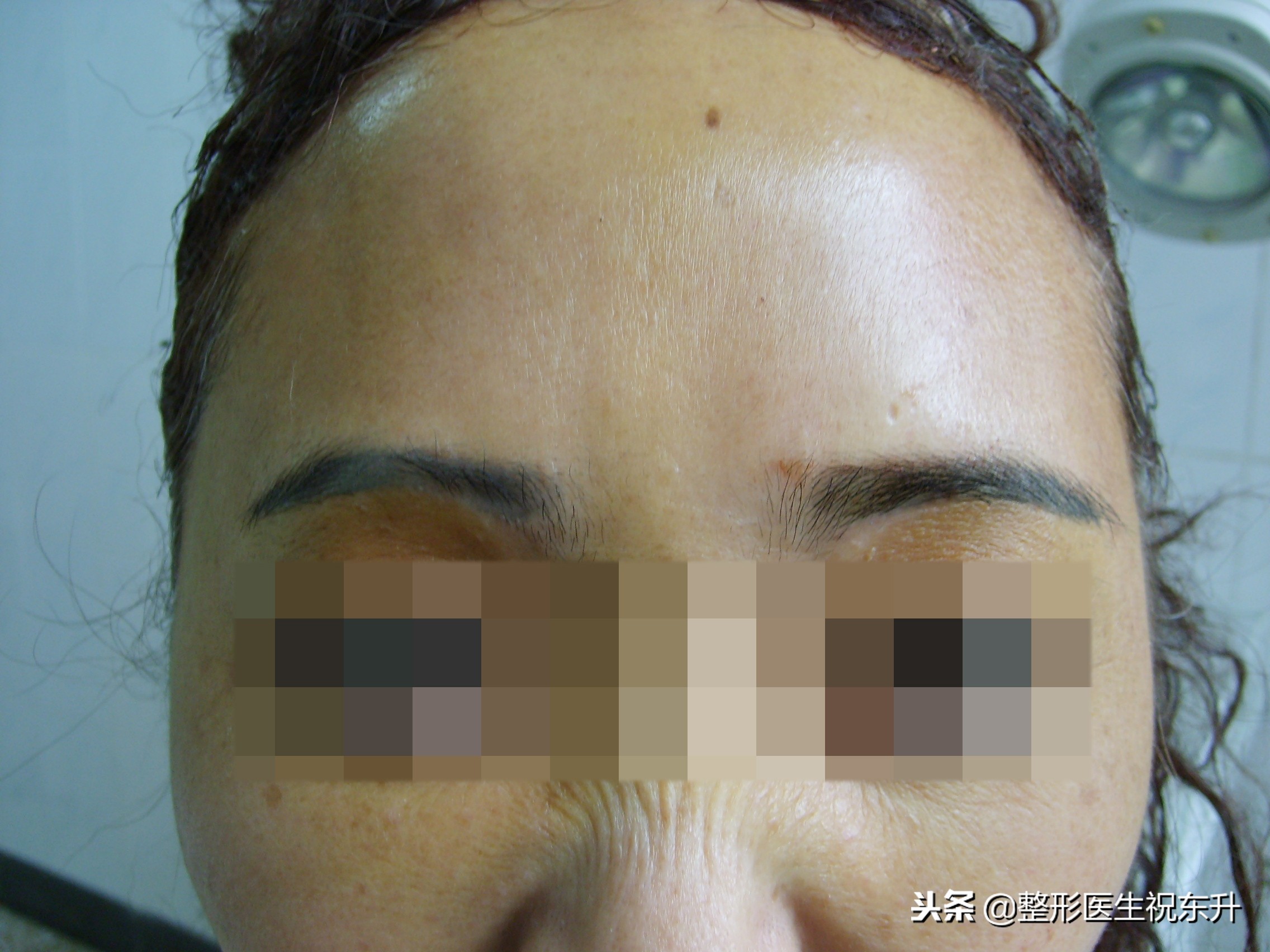 额颞部除皱去抬头纹怎么样,拉皮除皱抬头纹全过程视频