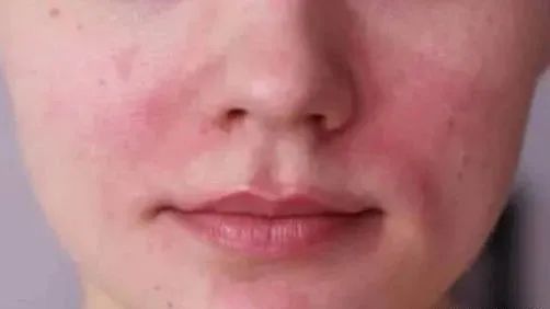 面部经常发红怎么修复,面部发红过敏是什么原因