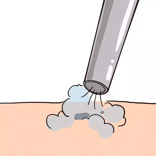 激光祛痣亲身经历和感受,激光祛痣亲身经历