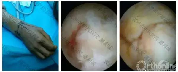 腱鞘囊肿除了手术还有什么办法,下颚有囊肿可以做穿刺手术