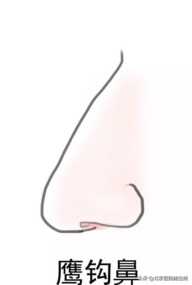 天生鼻型不完美怎么办呢,八种鼻型不佳图片