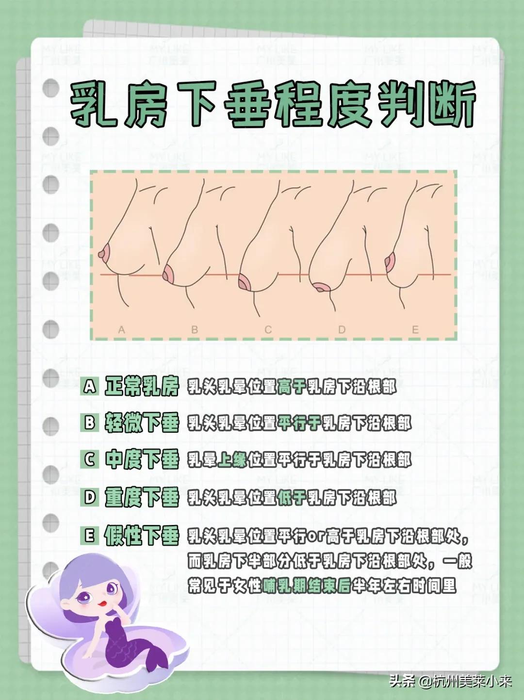 乳房下垂干瘪程度判断,乳房下垂等级怎么检测