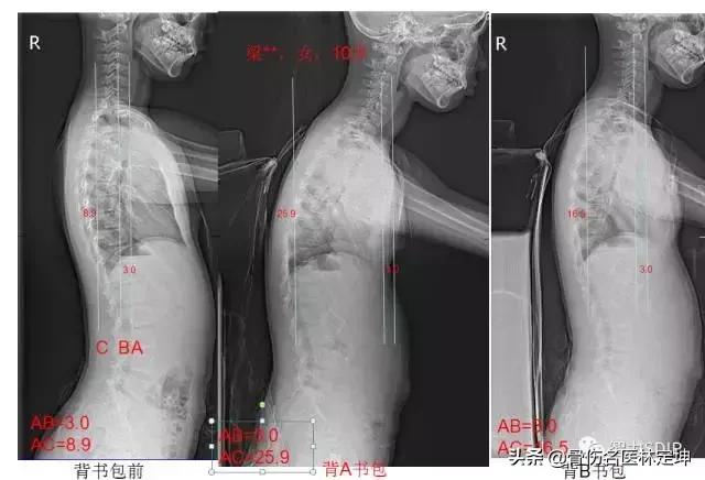 对孩子脊柱好的书包,书包对脊柱侧弯的影响