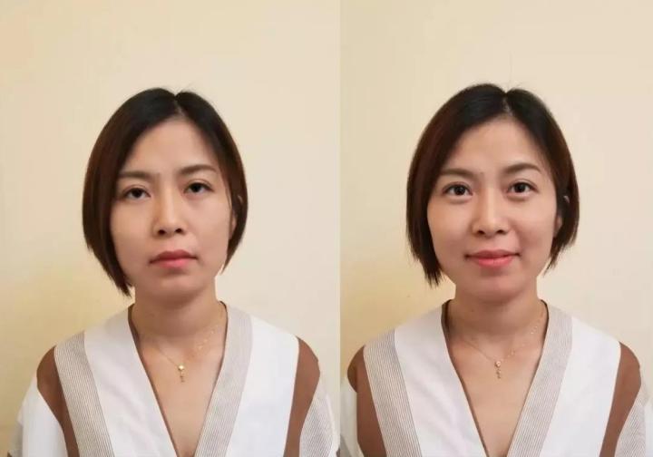 抗衰不再是简单的面部抗衰,风靡全球面部抗衰的最好方法