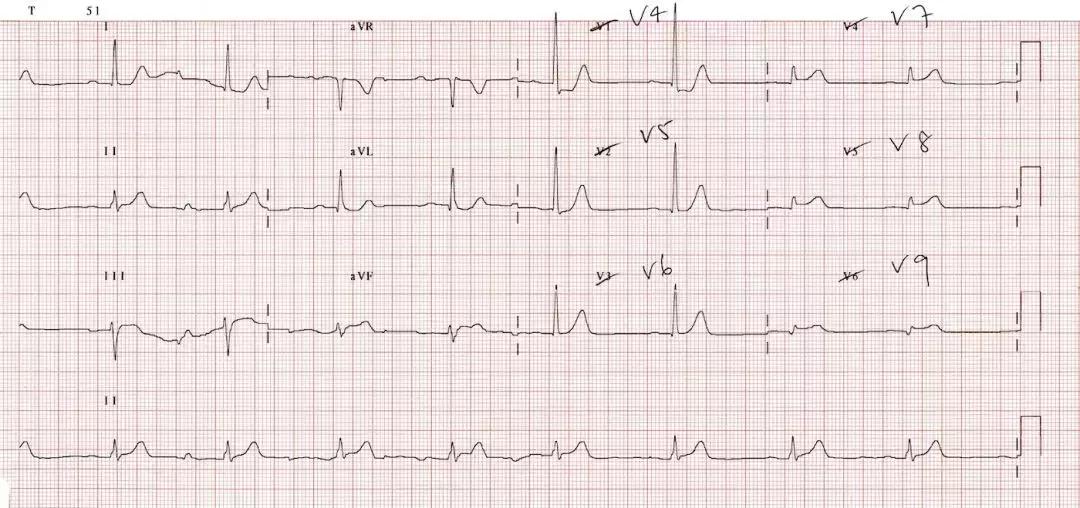 心电图和心脏彩超以哪个为准,心电图和心脏超声是一样吗