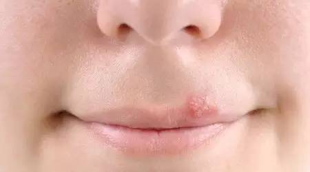 口腔溃疡是不是疱疹性口腔炎,口腔的常见20种疾病及治疗方法