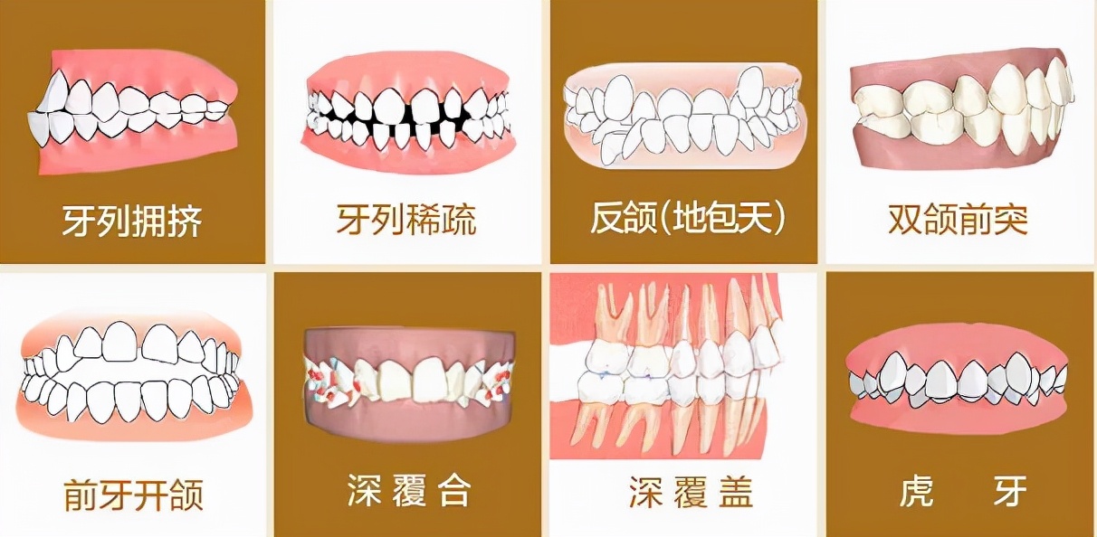 上海牙齿贴面美白修复,矫正牙齿的黑三角瓷贴面
