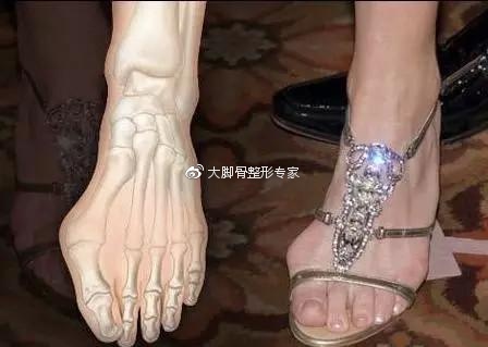 有大脚骨怎么办,让人尴尬的大脚骨该怎么解决