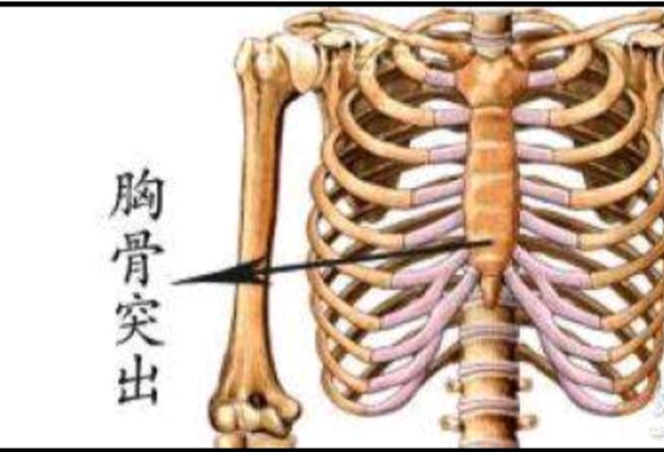 儿童缺钙鸡胸表现,鸡胸缺钙如何消除