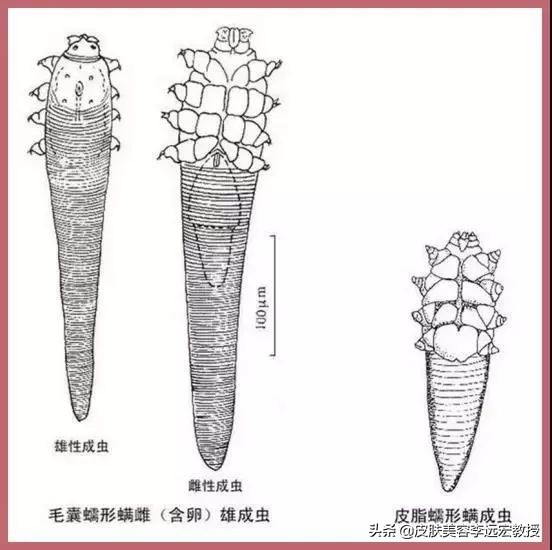爱长痘的人一直长痘,爱长痘痘的皮肤