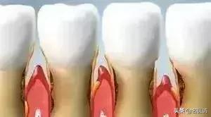 牙龈萎缩是什么原因引起的,牙龈萎缩专用药