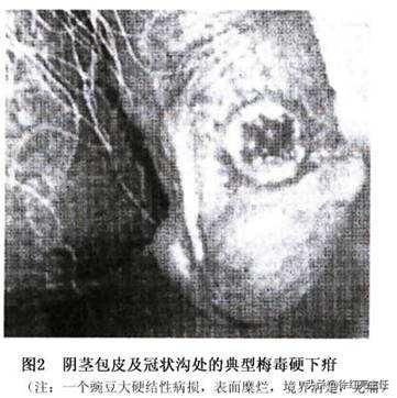 手掌脚掌红疹是梅毒吗,手掌唯一一个红疹会是梅毒吗