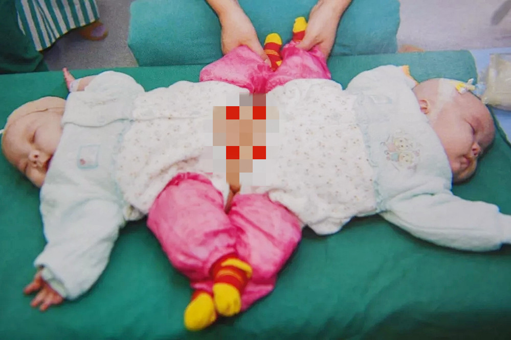 双胞胎坐骨连体成功案例,坐骨连体姐妹分离成功了吗