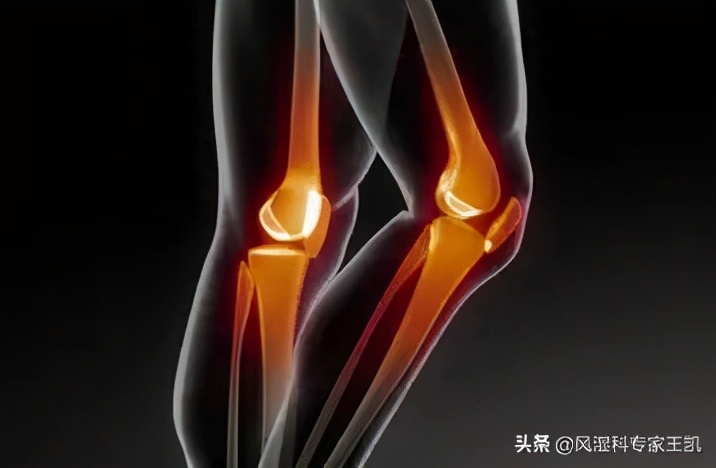 关节炎用冲击波治疗效果好吗,关节炎怎么治疗效果好